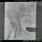 Fluoroscopia Arteriografía ilíaca interna