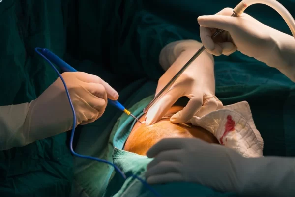 Electrocirugía Monopolar vs. Bipolar: ¿Cuál es la diferencia y cuándo usar cada una?