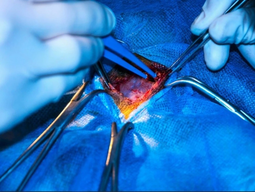 Electrocirugía Monopolar vs. Bipolar